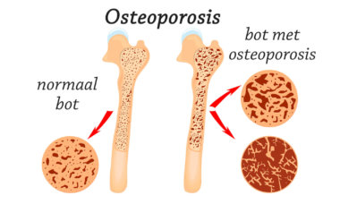 Osteoporose in botten