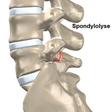 spondylolyse