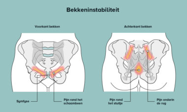 Bekkeninstabiliteit schematisch Fysio Masters