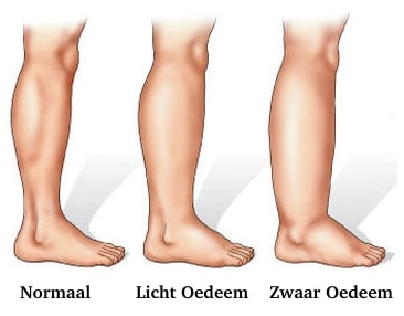 oedeem fysio masters fysiotherapie eemnes fysiotherapie laren