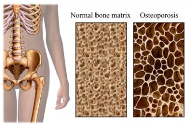 osteoporosis Fysio Masters Eemnes, Fysio Masters Laren, Blaricum, Bussum, Huizen, Baarn