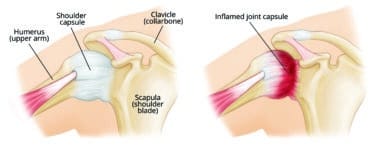 Frozen shoulder 3 1